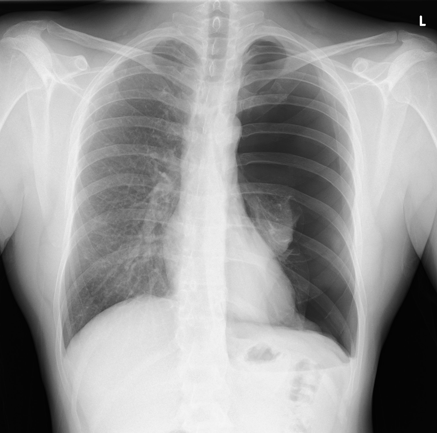 large-spontaneous-pneumothorax.png