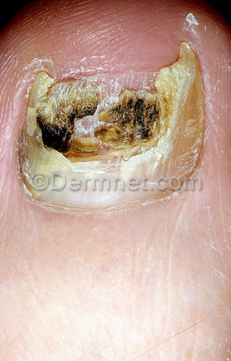 distal-subungual-onychomycosis-86.jpg