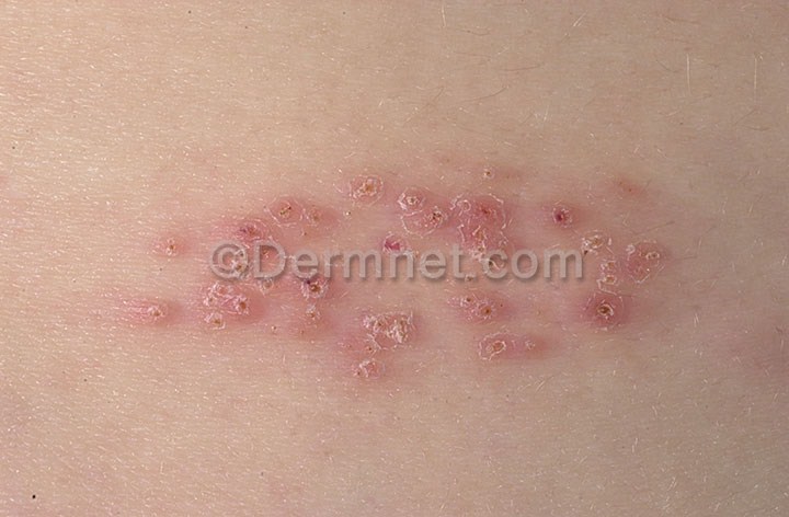 herpes-simplex-55.jpg