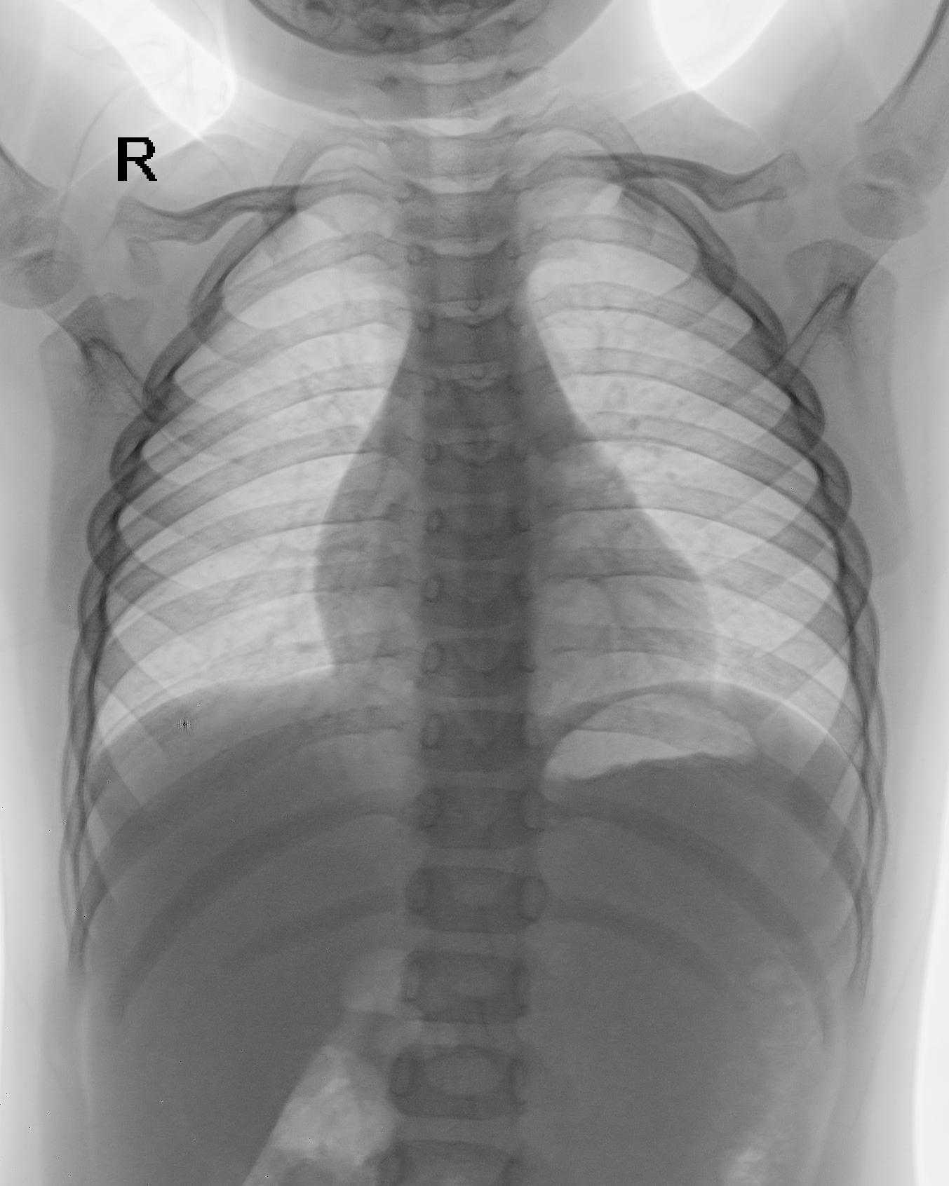 2e3204c2bb7a8fcdd6ec1ed547e2967e.dicom.jpeg