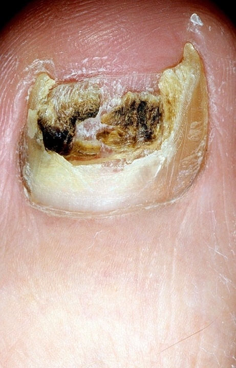 distal-subungual-onychomycosis-86.jpeg