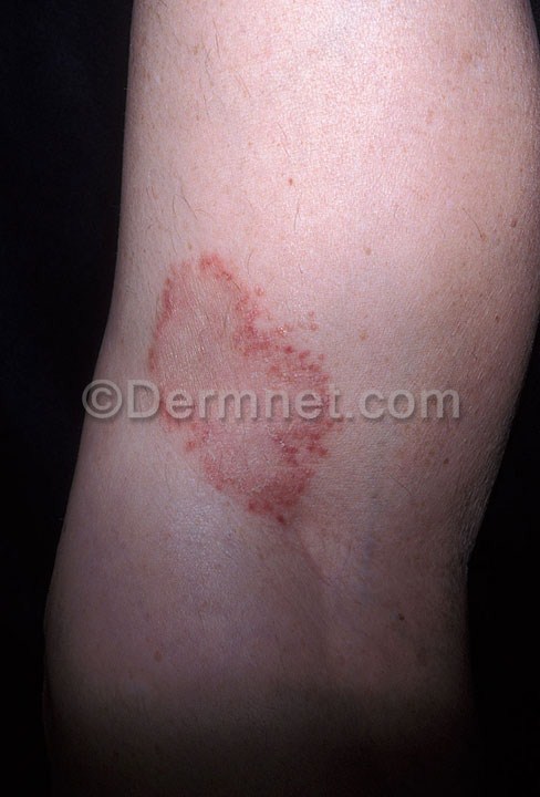 tinea-body-137.jpg