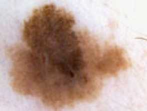 malignant-melanoma-16.jpg