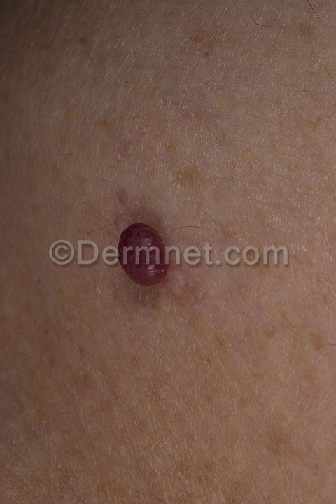 cherry-angioma-16.jpg