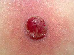 cherry-angioma-16.jpg