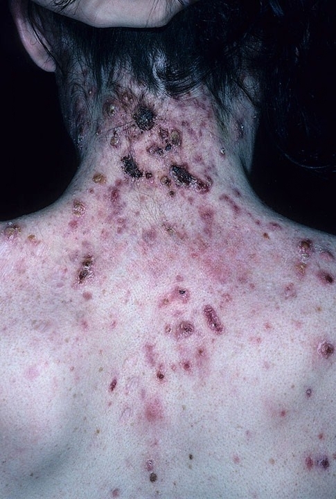 tinea-primary-lesion-15.jpeg