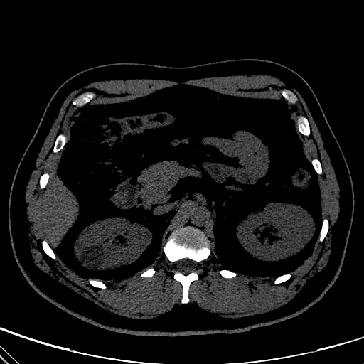 Cyst.jpg